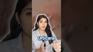 How to Get Rid of Urticaria Fast Hives [upl. by Rickey]