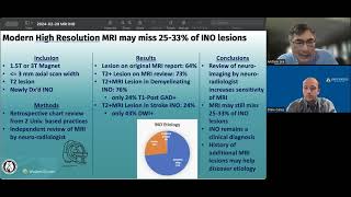 Internuclear Ophthalmoplegia INO on MRI [upl. by Eittak]