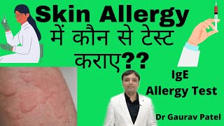 Test in skin allergy in Hindi  स्किन ऐलर्जी में कौन से रिपोर्ट कराए SIgE amp Allergy test [upl. by Dyna]