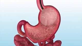 Intragastric Balloon Procedure  The Longstreet Clinic [upl. by Ayerf965]