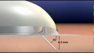 EN The OmniPod System Under the Hood [upl. by Cecelia]