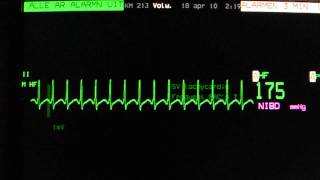 AV nodal reentry tachycardia AVNRT on an ECG heart monitor [upl. by Icam]