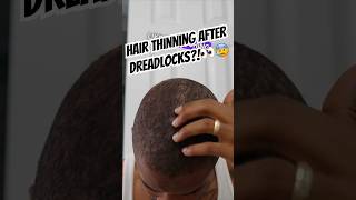 Hair Loss After Dreadlocks  Traction Alopecia👀 alopeciajourney [upl. by Aihsek]