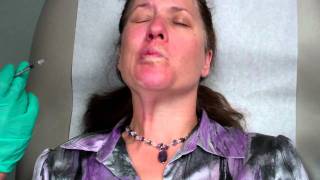 Botox Treatment for Bells Palsy [upl. by Yadrahs564]