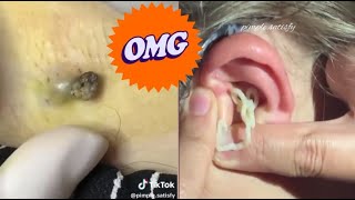 Blackhead Popping Extravaganza Satisfying Skin Care Moments [upl. by Powe]