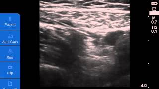 Ultrasoundguided Adductor Canal Block [upl. by Idonna856]