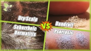 Dry Scalp vs Dandruff vs Seborrheic Dermatitis vs Psoriasis [upl. by Hecklau]