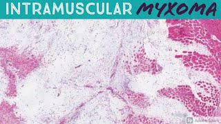 Intramuscular Myxoma 5Minute Pathology Pearls [upl. by Ikey]