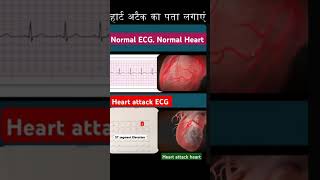 Normal ECG vs Heart Attack ECGshorts [upl. by Adnima]