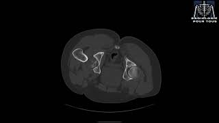 SCANNER DE LA HANCHE Fracture comminutive complexe de la hanche avec luxation [upl. by Thia]