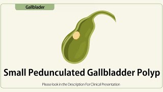 Small Pedunculated Gallbladder Polyp [upl. by Smart683]