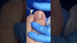 Extracción de uña encarnada onicocriptosis podologo satisfying ingrowntoenail [upl. by Lewert]