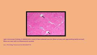 Neurology Quiz 101 Immune mediated necrotizing myopathy IMNM [upl. by Johanan]