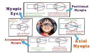 Myopia  Introduction and Etiology within 3 min 15 [upl. by Janice]