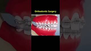 Ortho Treatment open bite العلاج التقويم للعظه المفتوحه 🎖️👌 [upl. by Birchard373]