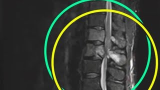 Spinal Metastasis for the Fellowship Exam [upl. by Cila]