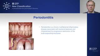 New classification of periodontitis [upl. by Fleischer912]