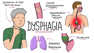 Dysphagia  Oropharyngeal amp Esophageal Dysphagia CausesDifferential Diagnosis Signs Treatment [upl. by Yedorb]