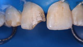 class IV preparation for composite build up  clinical case [upl. by Mitchell]