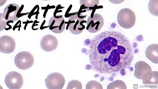 Platelet SatellitismSatellitosis from EDTA amp Pseudothrombocytopenia Hemepath amp Hematology [upl. by Arianna]