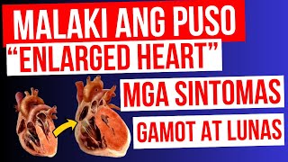 ENLARGED HEART  Lumalaki ang PUSO  Mga Sintomas Gamot at LUNAS  Cardiomegaly Heart Failure [upl. by Doughty541]