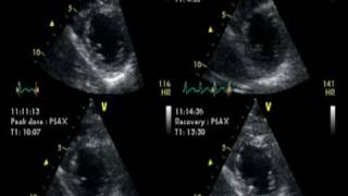 DOBUTAMINE ECHOCARDIOGRAM  ECHOCARDIOGRAPHIE DE STRESS NORMAL [upl. by Annaert]