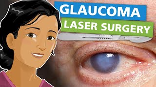 Glaucoma Laser Surgery [upl. by Marys454]