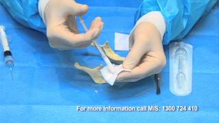 Bone Grafting simplified with BondBone by MIS [upl. by Asetal]