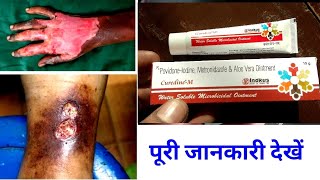 Povidone iodine Metronidazole amp Aloe Vera Ointment Uses Or Side Effects in hindi [upl. by Dyson]