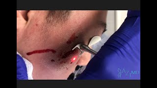 Acne Scar Laser Surgery [upl. by Leena555]