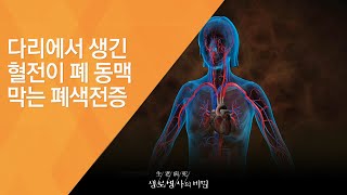 다리에서 생긴 혈전이 폐 동맥 막는 폐색전증  20091022444회 방송붓고 무겁고 아픈 다리 정맥질환 [upl. by Aneed487]