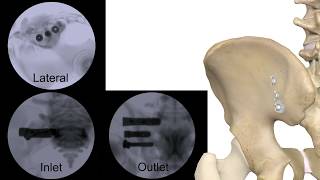 Corelink Entasis Sacroiliac Joint Fusion [upl. by Barnard]