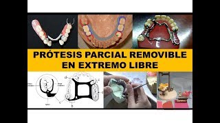 Prótesis Parcial Removible Tips sobre Diseño y Encerado de un removible metálico [upl. by Olatha]