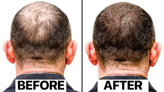 The Truth Behind This New Hair Loss Treatment  Exosomes [upl. by Eintihw]