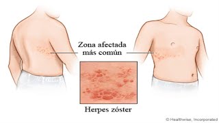 🔴 Se DEBEN REVENTAR las AMPOLLAS DERMATOLOGA EXPLICA drapilarochoa  Dermatologa [upl. by Zetroc374]