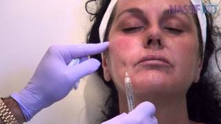 How To Use Blunt Cannula for Facial Fillers  Dr Paul Nassif [upl. by Angelia]