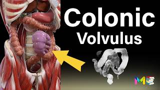 BOWEL OBSTRUCTION Colonic Volvulus [upl. by Consalve]