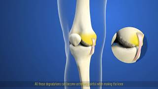 THUASNE Action Reliever Osteoarthritis patient video wwwactionrelievercouk [upl. by Clarinda598]