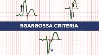 Sgarbossa Criteria  MEDZCOOL [upl. by Attennaj]