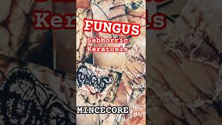 FUNGUS  SEBHORRIC KERATOSIS Mincecore Lovers VORACIOUS PRURITUS IN NECROTIC HARMONY EP [upl. by Bobbe578]