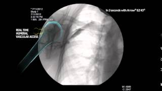 Arrow® EZIO® Infusion Fluoroscopy Proximal Humerus MC000631 [upl. by Gregorio]