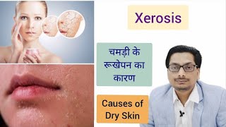 Causes of Dry Skin  Part 1 चमड़ी के रूखेपन का कारण  Xerosis  Xeroderma dryskin Winter Skin Care [upl. by Ebocaj139]