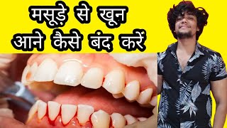 मसूड़ो से खून आना  BLEEDING IN GUMS TREATMENT IN HINDI  Omnident Paste Vit C Ostocalcium Tablet [upl. by Hael]