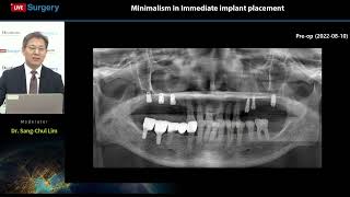 Dentium 220902 Live Surgery  Minimalism in immediate implant placement [upl. by Sybil]