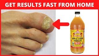 Apple Cider Vinegar for Toenail Fungus [upl. by Krefetz]