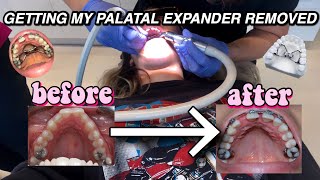 GETTING MY PALATAL EXPANDER REMOVED VLOG  BEFORE AND AFTER 1 YEAR LATER [upl. by Koerlin]