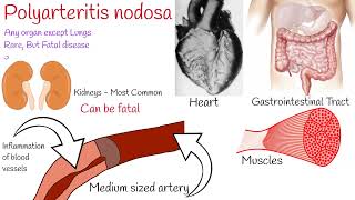 Polyarteritis nodosa  symptoms and treatment [upl. by Wiltz81]