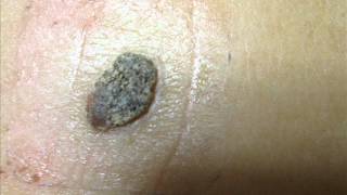 Mole Removal using Tea Tree Oil [upl. by Aline]