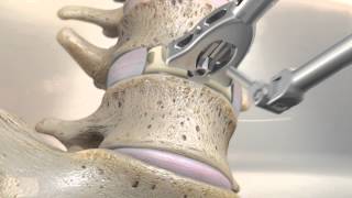 STALIF M™ MIDLINE II Surgical Technique Animation  Anterior Lumbar Interbody Fusion [upl. by Lobiv]