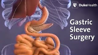 Gastric Sleeve Surgery  Duke Health [upl. by Enwad]